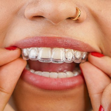 Close-up of woman placing Invisalign® aligner on upper teeth
