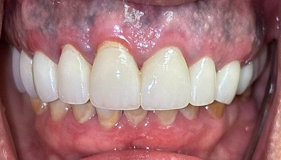 Close up of smile with front teeth replaced with dental implants