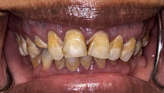 Close up of smile with front teeth missing