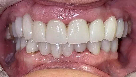 Overhead shot of teeth after treatment