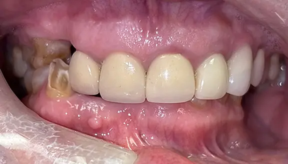 Overhead shot of teeth before treatment