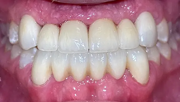 Overhead shot of teeth after treatment