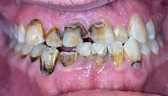 Overhead shot of teeth before treatment