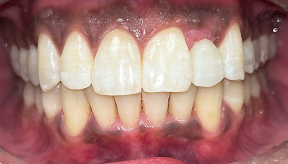 Overhead shot of teeth after treatment
