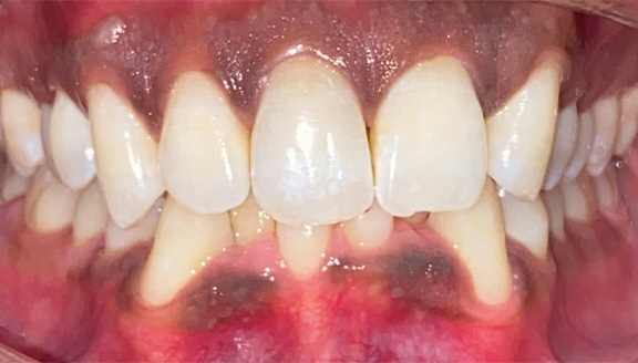 Overhead shot of teeth before treatment