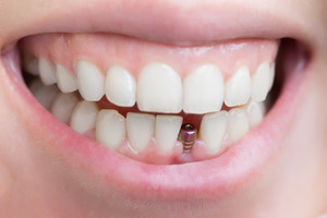 Unrestored dental implant in patient’s mouth